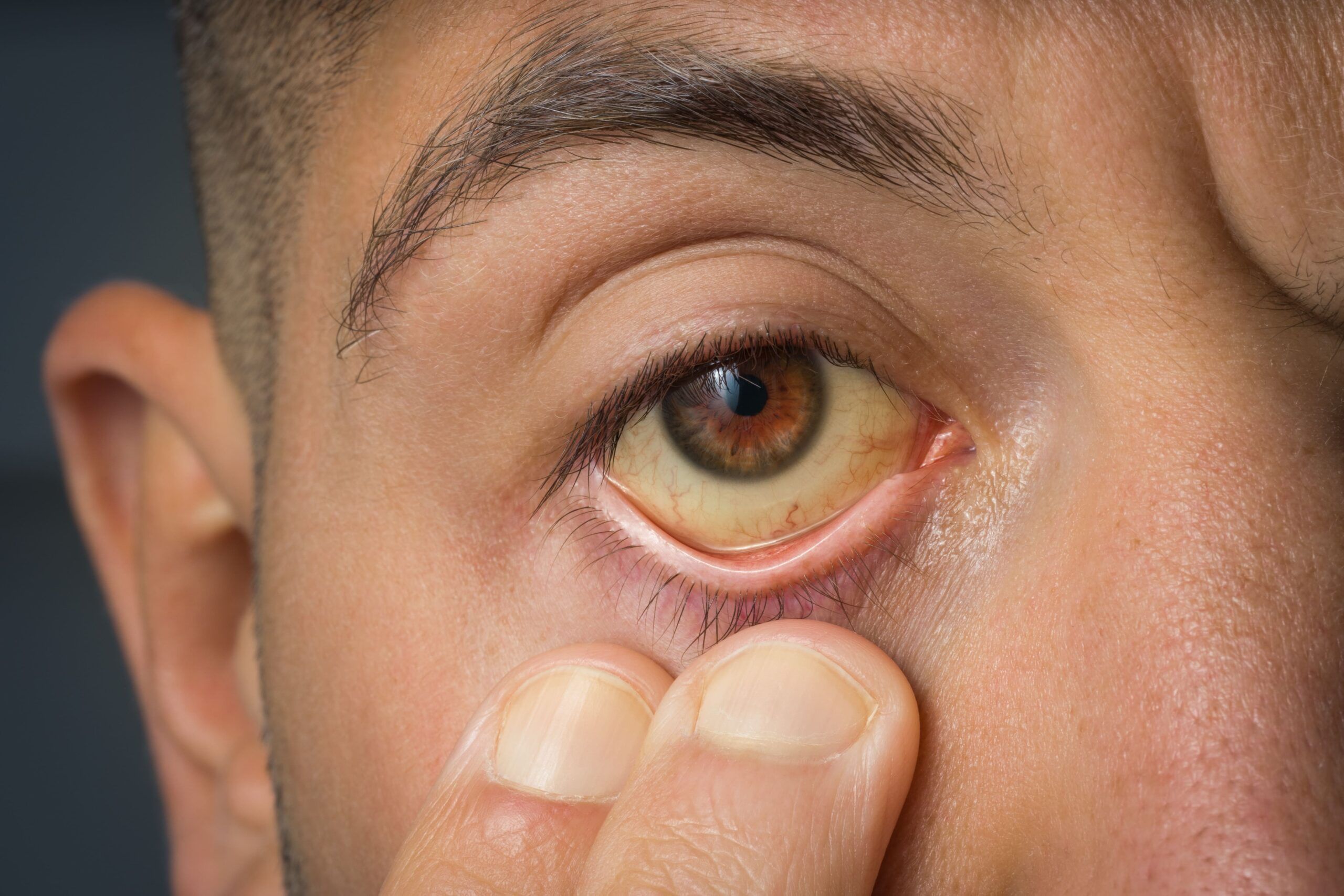 Man with yellow eyes from drinking alcohol