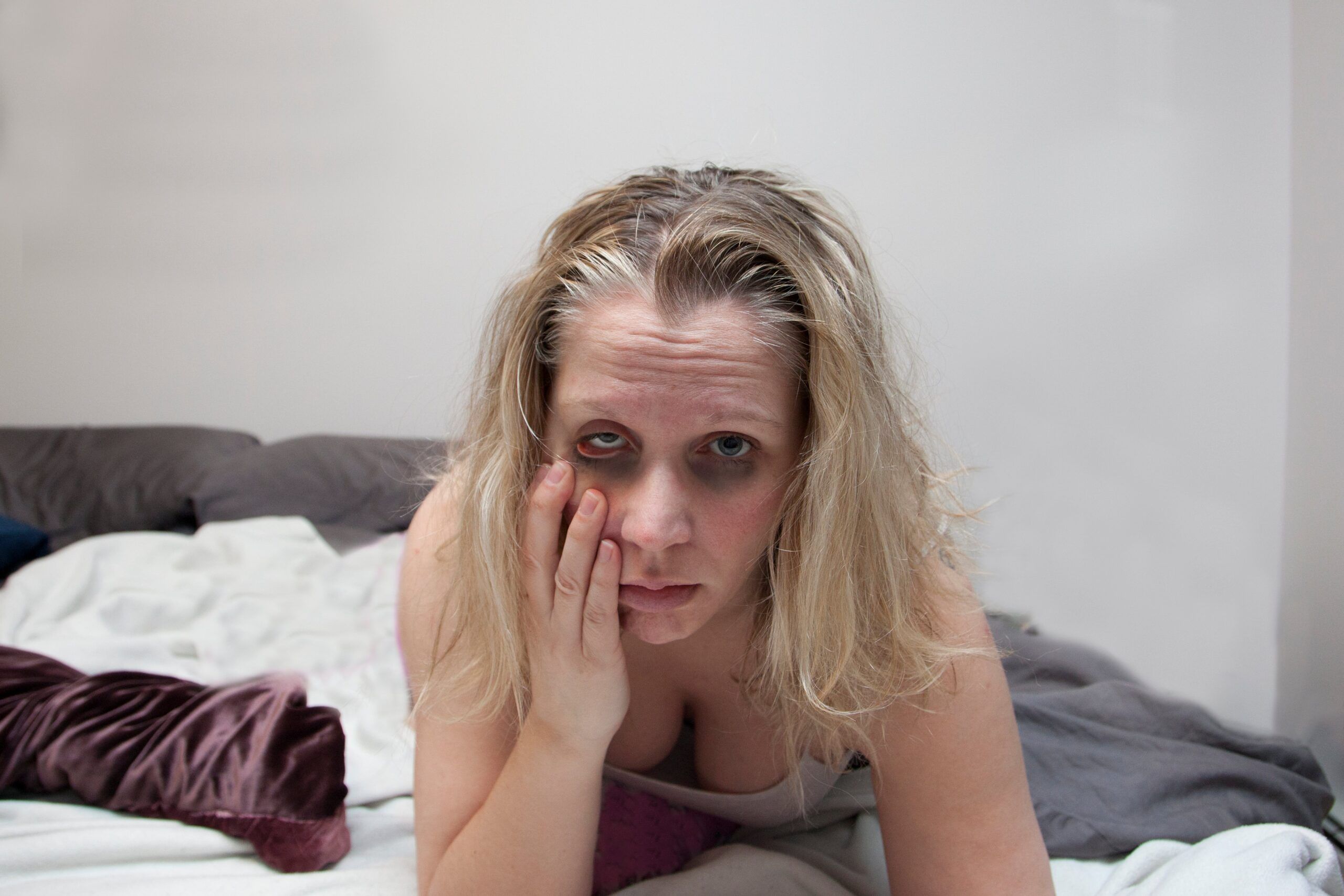 Woman going through alcohol induced psychosis